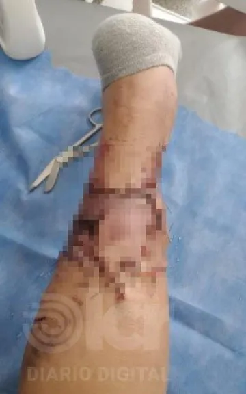 Las mordeduras y las graves lesiones se produjeron en la pierna izquierda. Foto gentileza.